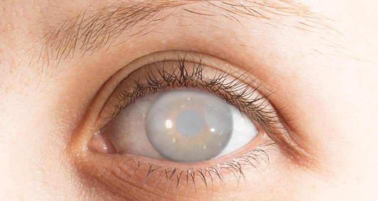 Katarakta: 7 ankstyvieji labiausiai paplitusios akių ligos požymiai