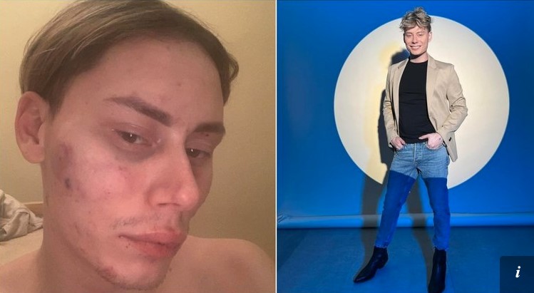 Ąžuolas Misiukevičius prakalbo apie santykiuose patirtą smurtą: „Pastarosios dienos man primena apie tai“