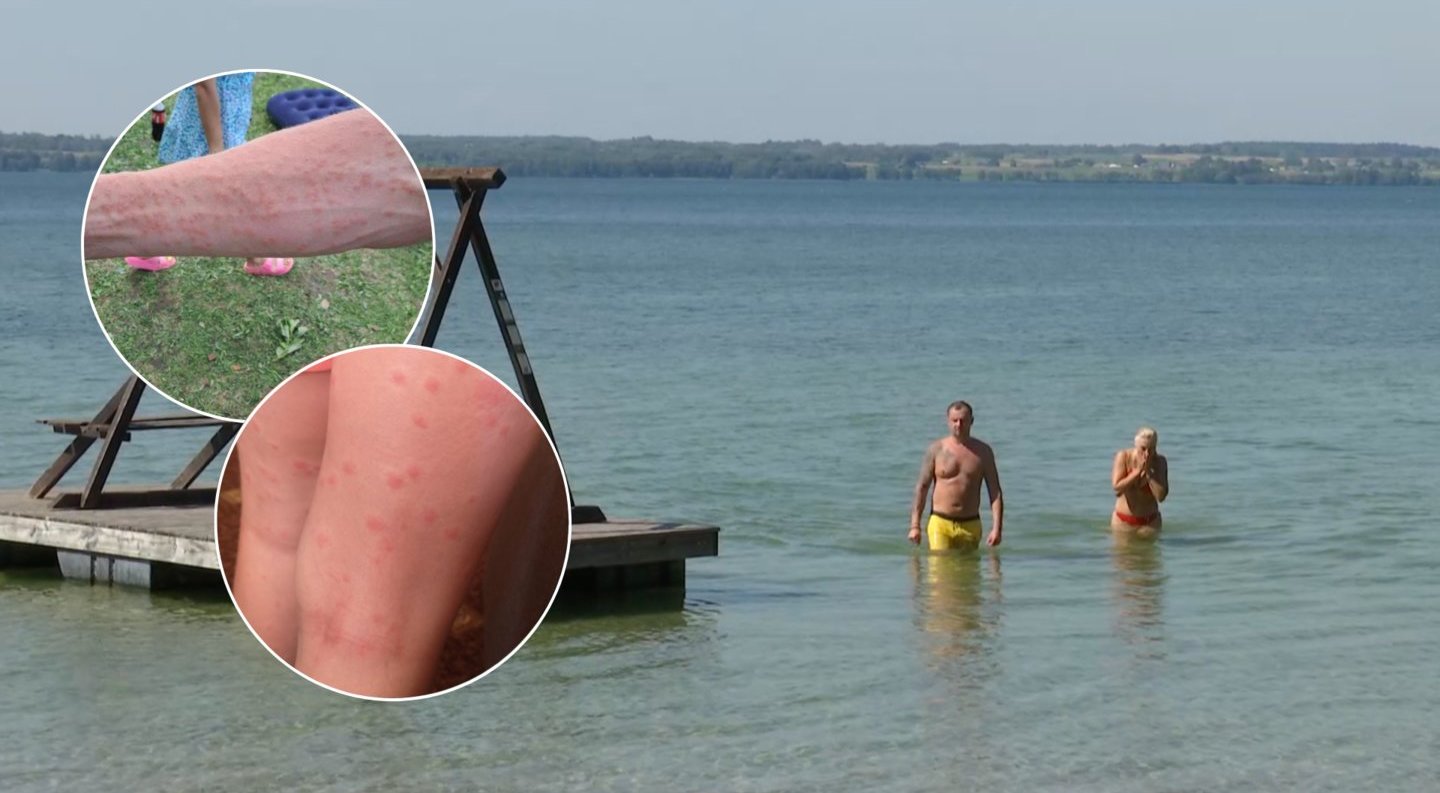 Išlindę iš vandens poilsiautojai net šiurpsta: „Kasiausi, o Jėzau. Ištinsta tie bumbulai“